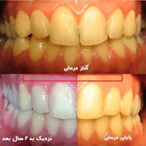 بعد از ارتودنسی